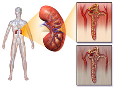 Diabetic Nephropathy