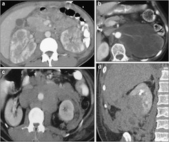 Imaging of Unusual Renal Tumors | Current Urology Reports