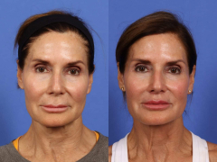 Lip Lift Before and After | W Cosmetic Surgery