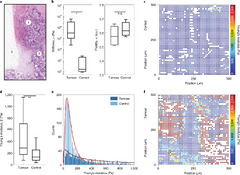 Rigid tumours contain soft cancer cells | Nature Physics