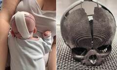 3D ing: Baby's life saved after surgeons use skull model to ...