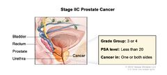 Prostate Cancer Treatment - NCI