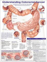 Understanding Colorectal Cancer Anatomical Chart by Anatomical ...