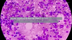 Acute Myeloid Leukemia