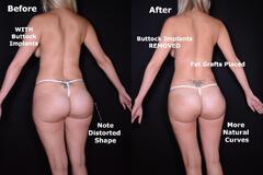 Brazilian Butt Lift for Panama City & Pensacola, FL | Destin ...