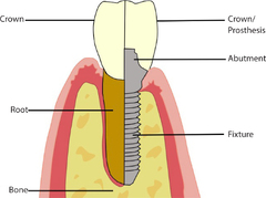 Dental Update - Dental Implants for the general dental ...