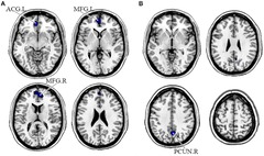 Frontiers | Altered brain functional networks in schizophrenia ...