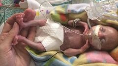 Born before 22 weeks, 'most premature' baby is now thriving | CNN