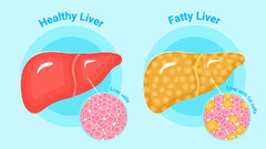 Fatty Liver Disease: Expert Explains Risk Factors And Prevention ...