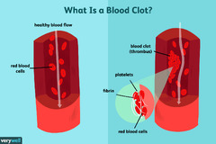 Blood Clot: Symptoms, Treatment, Prevention, and More