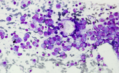 Multiple Myeloma