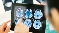 Understanding Brain Tumour: Key Facts and Insights