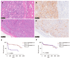 Hepatocellular carcinoma